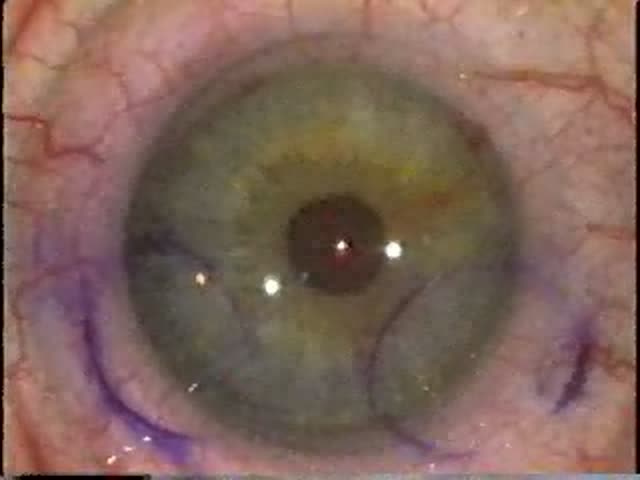 A frame from the original surgery film